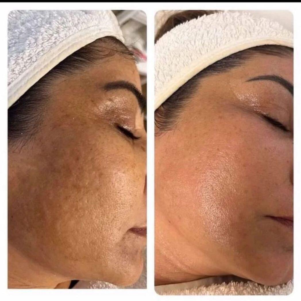 Crema Skin-care Koreano 2% Niacinamida Ácido Hialurónico (tipo Medicube)