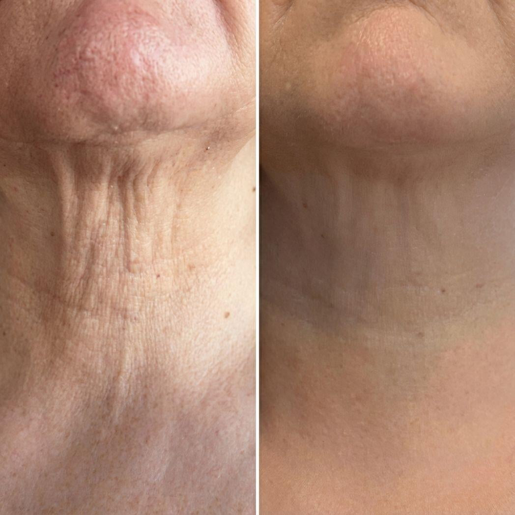 MASAJEADOR/Antiarrugas Rodillo 3D Integrado - Específico para cuello y rostro - Tratamiento Antiarrugas \ Jaysuing