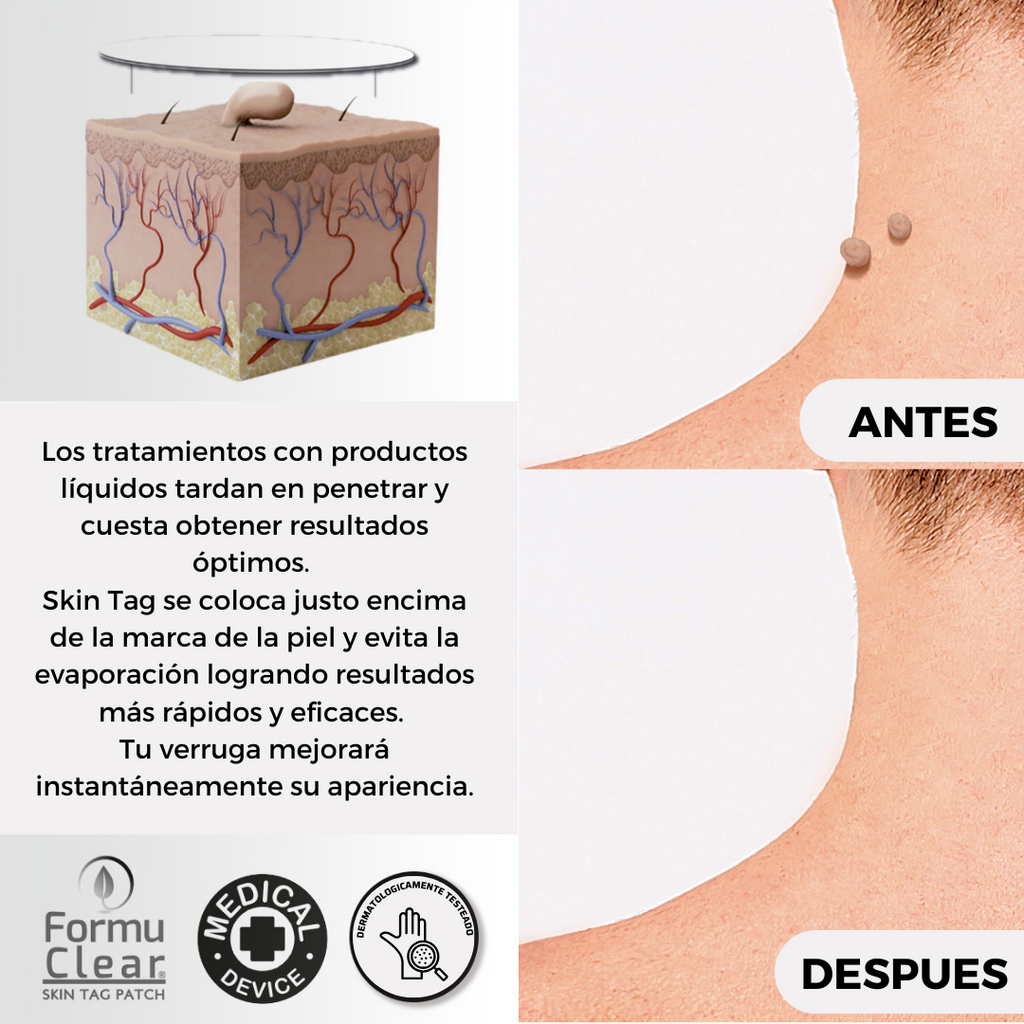 Parches para eliminar verrugas sin dolor