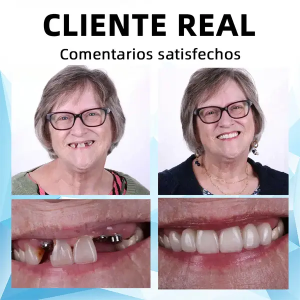 Prótesis Dental de Silicona - Sonrisa Instantánea y Cómoda