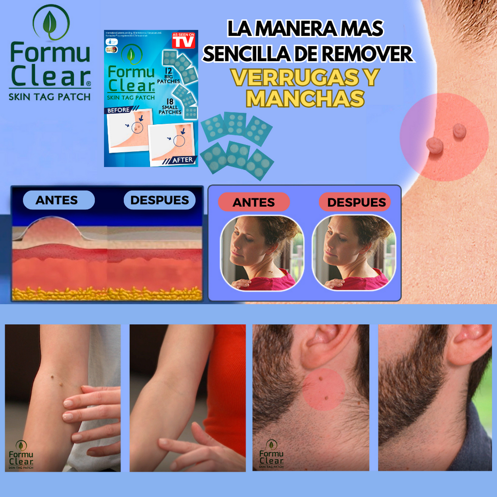 Parches para eliminar verrugas sin dolor